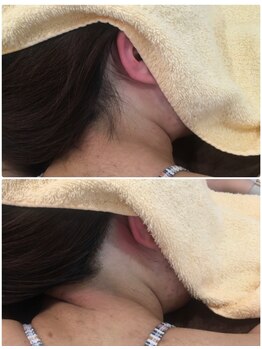 叶(Kanau)/うなじ脱毛