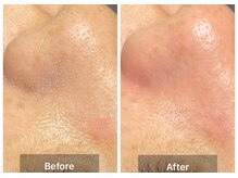 ステッラ(STELLA☆)/毛穴洗浄　Before/After