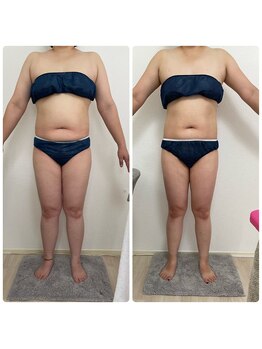 エステサロンブランシュ(Esthe salon Blanche)/ハイパーナイフ痩身