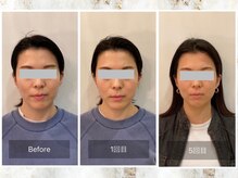 クレファ(CREFA)/美顔整骨症例