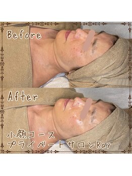 プライベートサロン レイ(Ray)/小顔コース