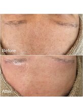 ラヴィアロマティックハーブ 高津 溝の口店(LaviAromaticHerb)/黒ずみケア