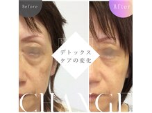 デトックスフェイシャル★ハードケアですが効果実感される方多数