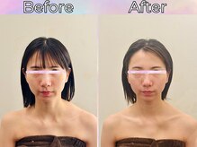 リストアハート(Restore Heart)/フェイスラインスッキリ小顔に