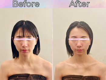 リストアハート(Restore Heart)/フェイスラインスッキリ小顔に