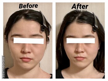 ショウフェイスデザイン(Sho Face Design)/《小顔矯正》ビフォーアフター