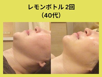 アユアランリンク 札幌店/レモンボトル/40代/2回