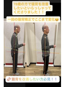 ホネツギ 柏駅西口接骨院(HONETSUGI)/【猫背矯正】before/after