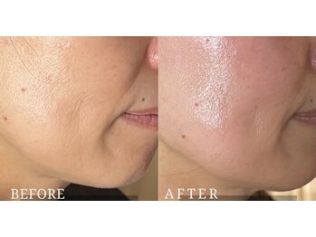 ロジワール(LOISIR)/ほうれい線の印象変化１回目