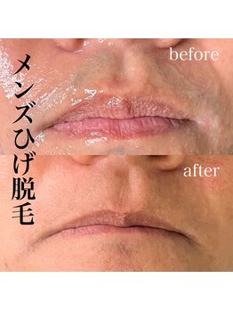 サロン リタ(Salon Rita)/メンズひげ脱毛☆