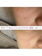 キュオバイアンドリープ(Qo by &LEAP)/光フェイシャル×エアバリ