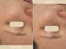 エクラ(eclat)/施術回数：1回