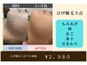 Men's!!【処理から解放！！】ひげ脱毛５点フル体験¥2980