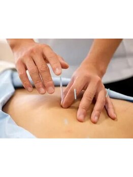 鍼灸施術を受けたい