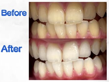 LBSホワイトニング 梅田店/ホワイトニングビフォーアフター