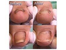 巻き爪補正店 越谷店の雰囲気(痛い~巻き爪も当店の補正技術で1度で痛みの緩和します!)