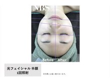 マイプラ(mypla)/光フェイシャル「リフトアップ」