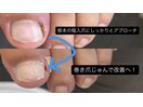 皮膚科で切っても痛い陥入爪施術