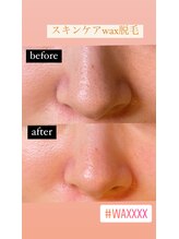 ブリラ(Briller)/【毛穴ケア】スキンケア脱毛