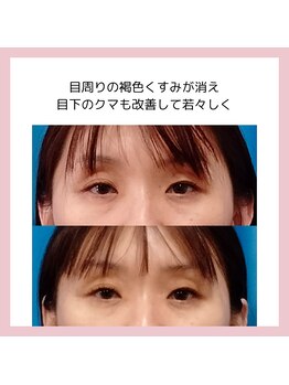 目元 口元のたるみ 眉間シワ改善専門サロン/目周りのくすみを消したい方向け