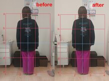 ゆずのき/首/肩コリ/歪み調整before after