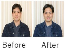 マホロ(MAHORO)/20代美容鍼ビフォー＆アフター