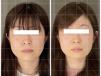 ソルビーフェイス(SOL*BeFace)/ブライダルフォトにむけて/8回目