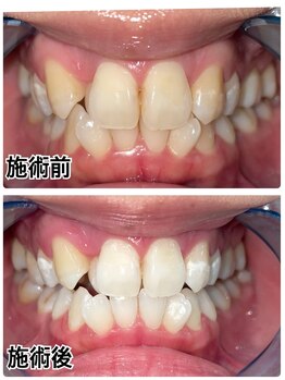 ホワイトニングビューティー 名古屋栄店(WHITENING BEAUTY)/セルフホワイトニング