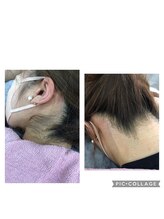 サロンシャイン(Salon Shine)/うなじ脱毛３０代後半女性