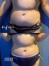 優来 神田店/お腹施術の例［神田/小顔］