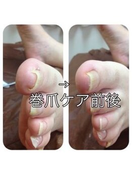 アロマルーム橙 plus/巻き爪予防