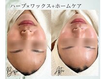 ポノ 茅ヶ崎(Pono.)/湘南/毛穴/ハーブピーリング