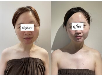 レシェルサロン(Lechelle Salon)/ハイパーナイフ小顔フェイシャル