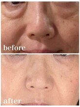 ルル 北仙台/お客様Before/After　シワケア