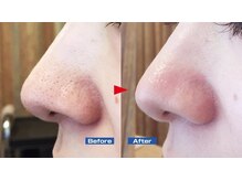 ハーシークレット(Her secret)/ハイドラ＋ポレーション