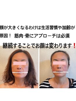 ナゴミ(NAGOMI)/エラ張りの改善ならこちらが1番