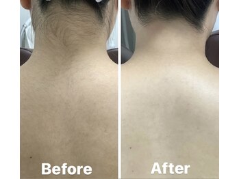 ルル(RuRu)/ Wax脱毛