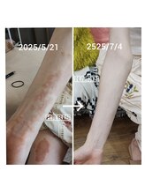 ハリス(HARIS)/前腕の赤み・痒み、ざらつき減