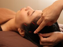 ハリラックス(HA:Ri/LAX)/【美容鍼灸の様子】