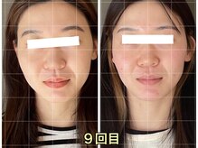 ソルビーフェイス(SOL*BeFace)/結婚式の為に☆9回目