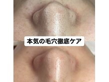 ビューティーネイル(Beauty Nail)/毛穴エクストラクション