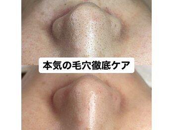 ビューティーネイル(Beauty Nail)/毛穴エクストラクション