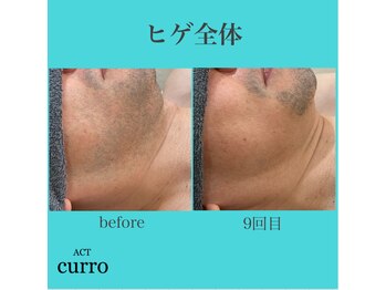 アクト クロ(ACT curro)/【ヒゲ全体】脱毛施術例