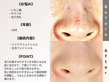 ルディラ 新宿店/ハイドラフェイシャル