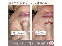 シストワ(sistoi)の雰囲気（ラジオ波WINBACKでほうれい線の原因になる表情筋を引き締める！）