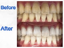 LBSホワイトニング 梅田店/ホワイトニングビフォーアフター