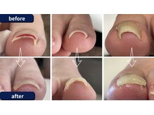 まき爪晴れる/痛みはその場で解消できます！