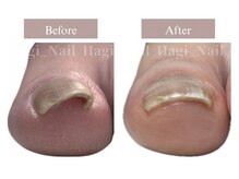 ハギネイル 吉川(Hagi_Nail)の雰囲気（プレート、専用ジェルを使った自社独自技術の巻き爪矯正）