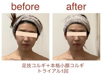 レアフィート(Rheafeet)/小顔の症例写真