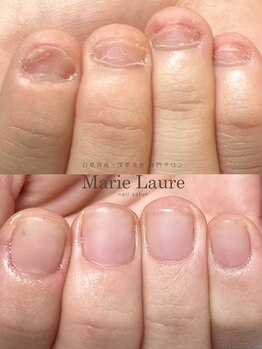 マリーロール 梅田店(Marie Laure)/自爪育成/深爪矯正/ネイルケア